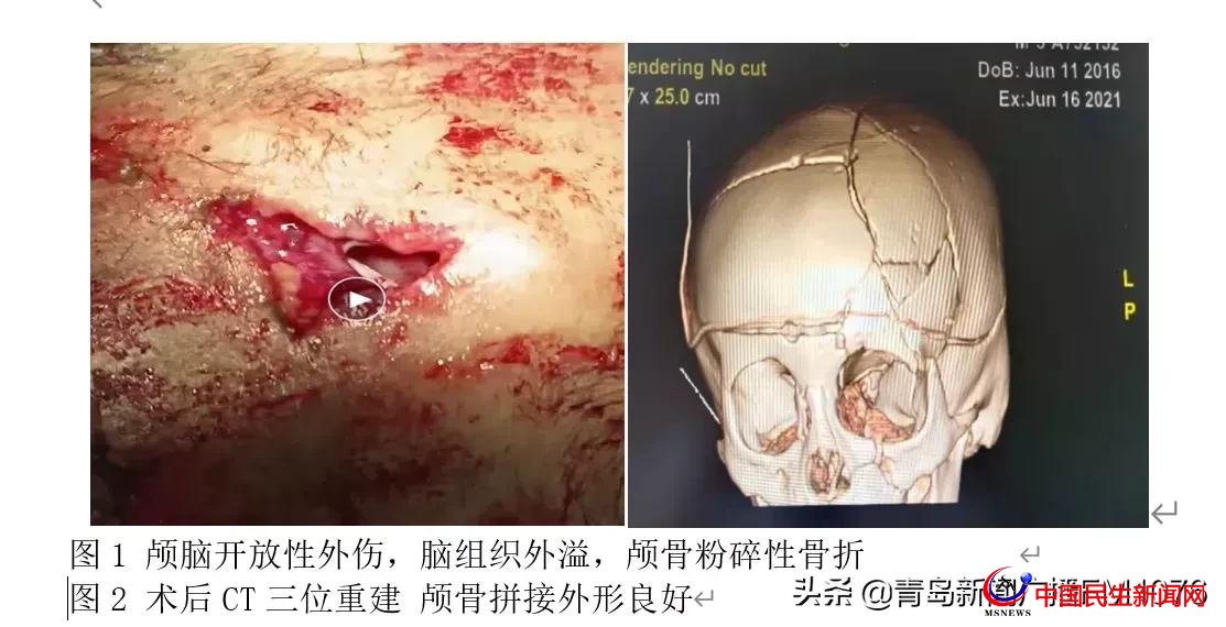 5歲男童6樓墜落命懸一線，婦兒醫(yī)院多學科協(xié)作再勝“死神”